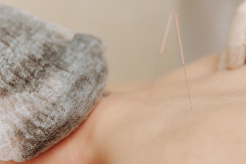 Acupuncture